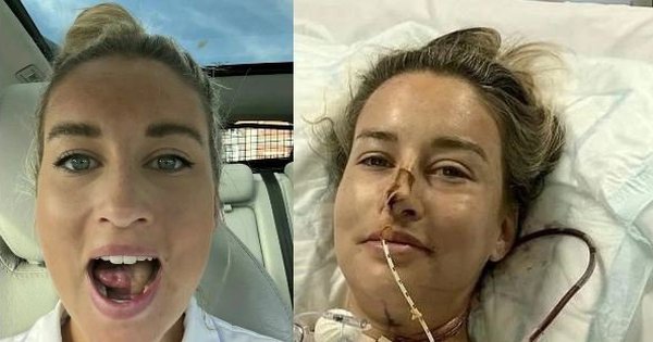 Nhiệt miệng mãi không khỏi, cô gái 27 tuổi đi khám phát hiện ung thư miệng phải cắt bỏ một nửa lưỡi