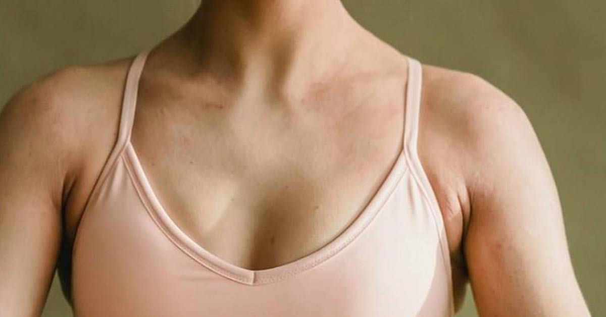 Thiếu nữ 17 tuổi mừng thầm vì ngực đầy đặn hơn, đi khám liền nhận kết quả gây sốc