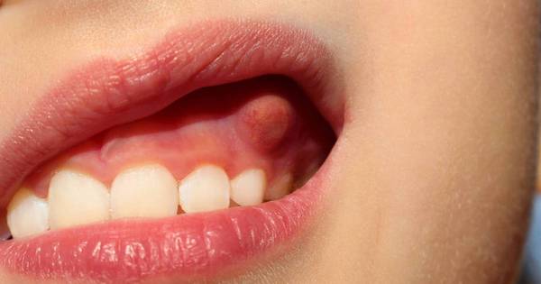 4 bất thường xuất hiện trong khoang miệng đang cảnh báo bệnh viêm nha chu, răng rụng ra mới phát hiện thì đã quá muộn