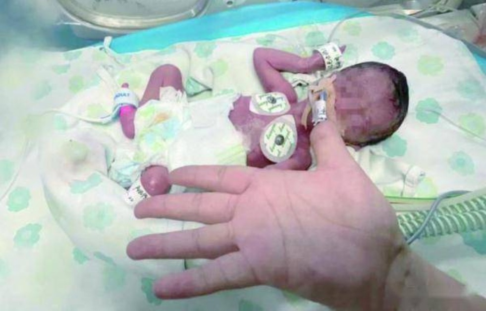 Chào đời nặng vỏn vẹn 6 lạng, bé gái tạo ra kì tích sau 3 tháng nằm viện