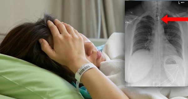 Cô gái nhập viện vì khó thở, bác sĩ bàng hoàng khi lấy ra dây sạc điện thoại dài 1 mét trong thực quản