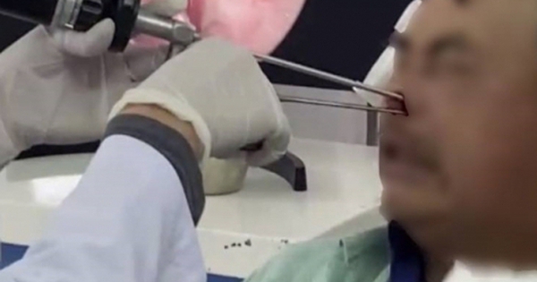 Gắp hơn 100 con giòi làm tổ trong hốc mũi bệnh nhân 53 tuổi