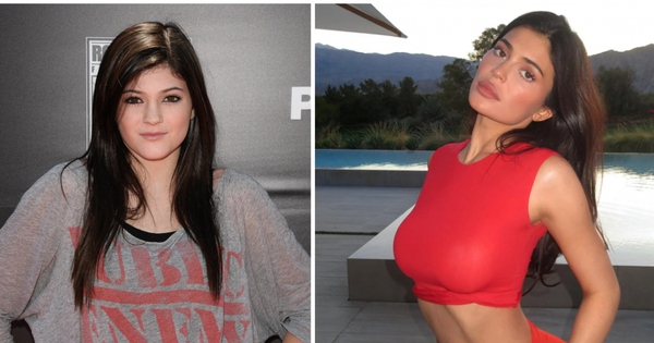 Kylie Jenner bị chỉ trích nói dối khi tuyên bố không phẫu thuật thẩm mỹ