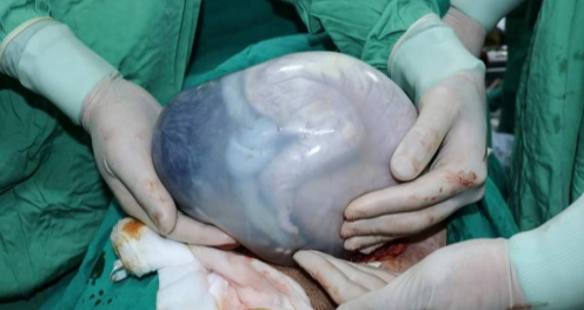 Em bé chào đời trong túi ối: Điềm lành số hưởng cả đời hay nguy hiểm rình rập?