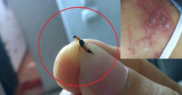Nhiều người bị viêm da do tiếp xúc với kiến ba khoang: Phân biệt kiến ba khoang đốt và bệnh zona