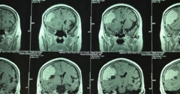 Đi khám đau đầu, phát hiện khối u màng não to hơn quả trứng