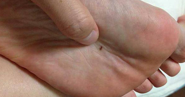 2 hiện tượng bất thường xuất hiện ở lòng bàn tay, lòng bàn chân cảnh báo tế bào ung thư đang nhen nhóm phát triển