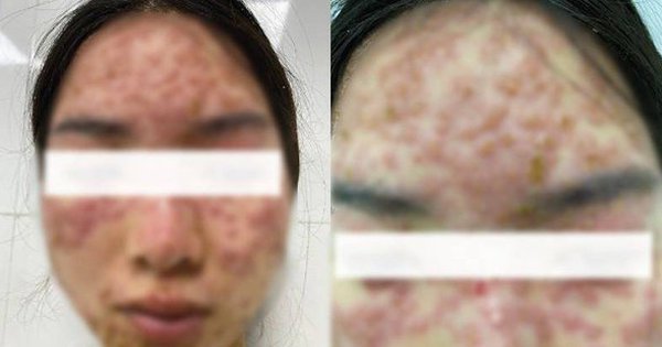 Đắp mặt "detox" tại spa, cô gái trẻ nhập viện với khuôn mặt đầy mụn